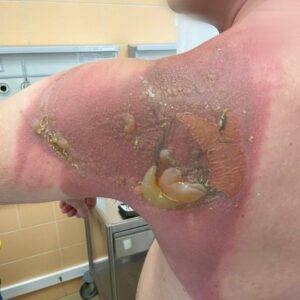 Мужчина получил химический ожог от постиранной простыни