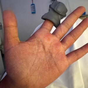 Вспышка лихорадки денге угрожает туристам на Мальдивах